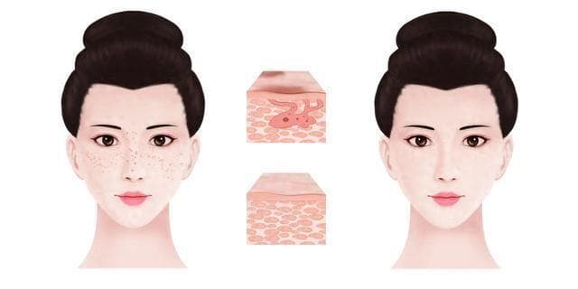 氨甲环酸治疗黄褐斑：你需要知道的几件事