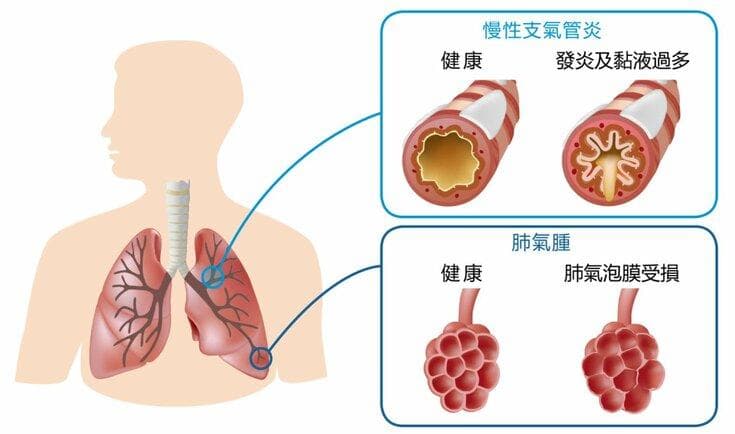 认识长期氧疗（LTOT）