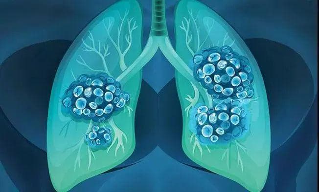 复旦大学研究团队揭示小细胞肺癌空间分子异质性及免疫互作生态位