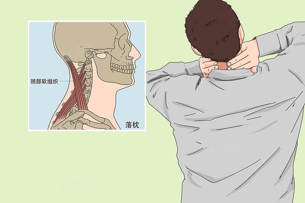 落枕了最快的恢复办法