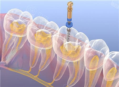 根管锉和扩大针的区别：根管锉用于初步清理和扩展|扩大针用于探通及扩大根管口径！