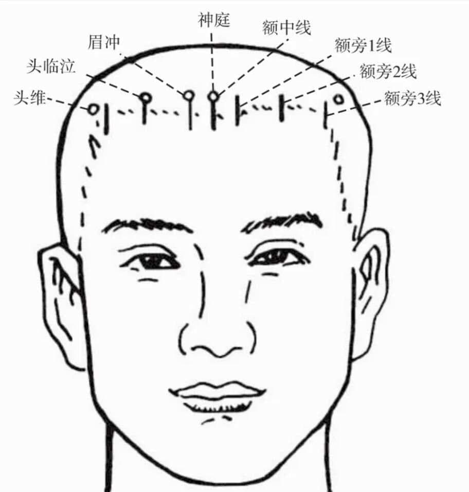 头针穴名国际标准化方案