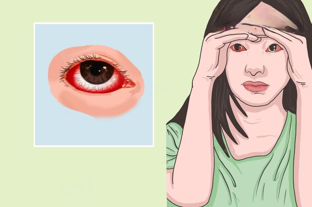 眼睛毛细血管出血的原因及处理方法
