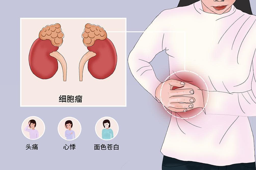 嗜铬细胞瘤术前准备