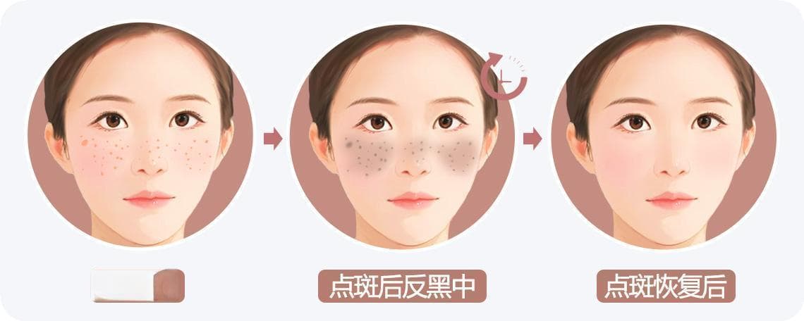 点斑后多久才能恢复正常皮肤？详解不同治疗方法的恢复期