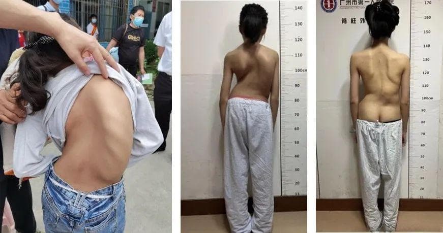 肩膀、腰部和臀部不对称?小心脊柱侧弯！