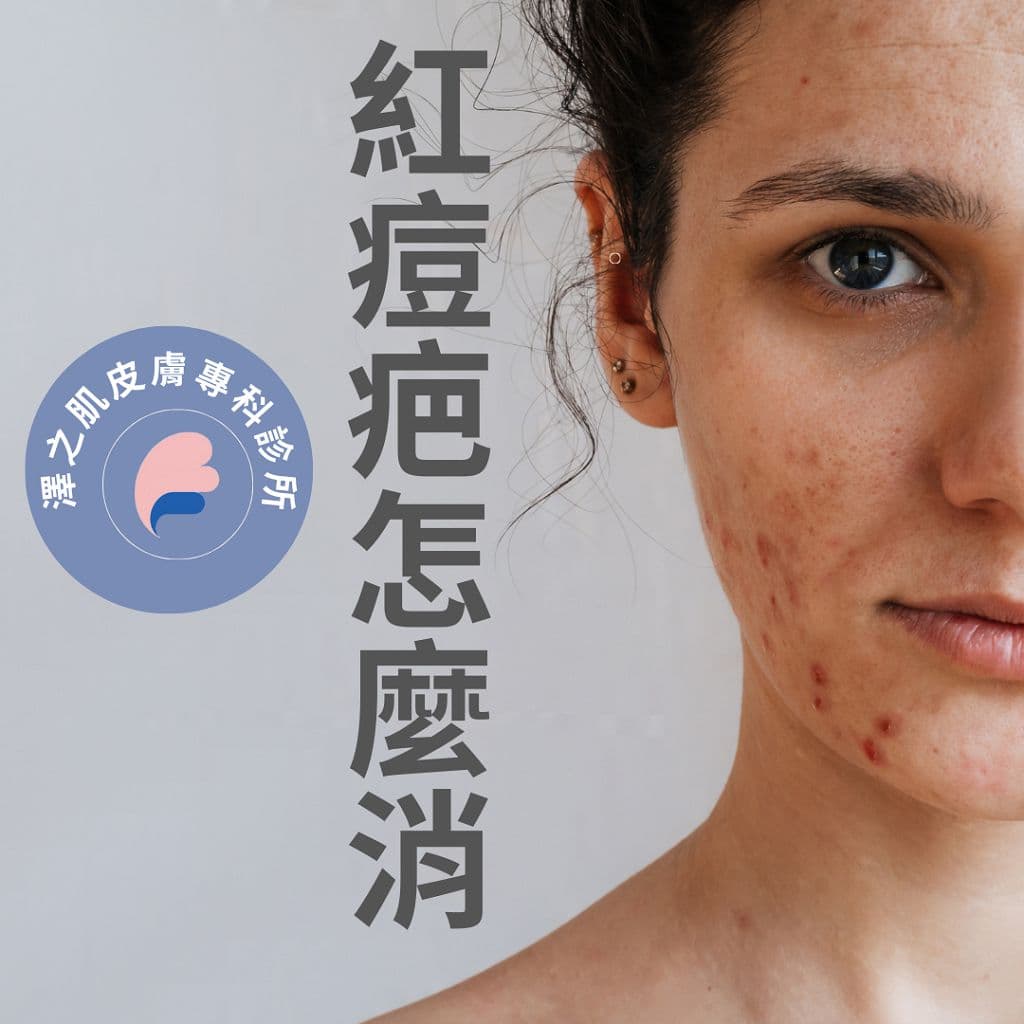 红痘疤怎么消？两大治疗方案与日常护理全攻略