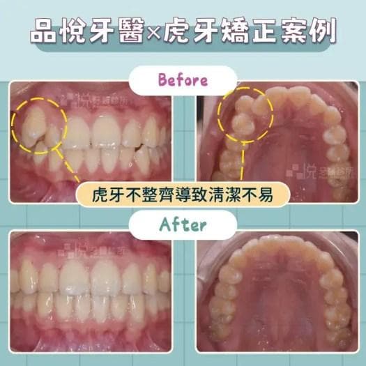 矫正虎牙真的要拔牙吗？不矫正会怎样？咬合问题、蛀牙风险你要知道