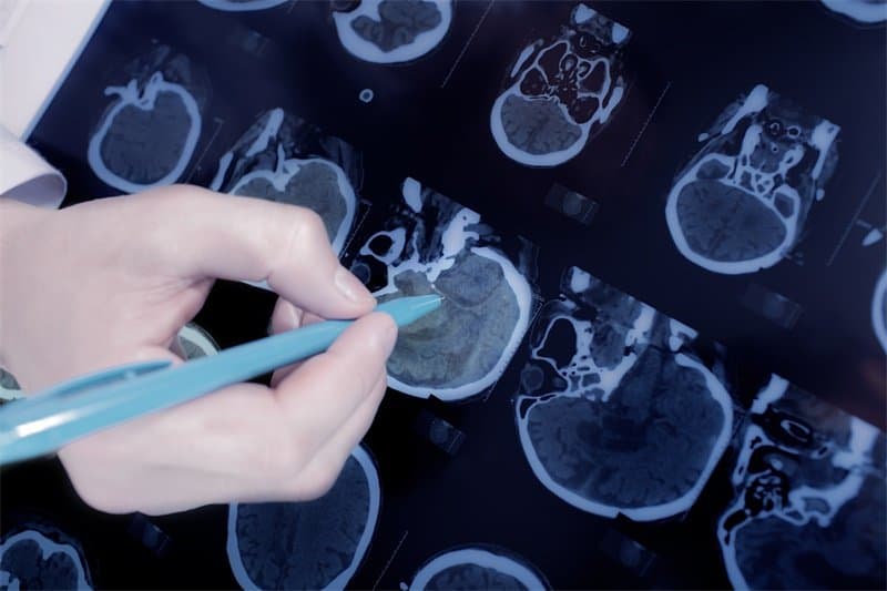 脑膜淋巴瘤：病因、症状、检查、治疗及护理全解析
