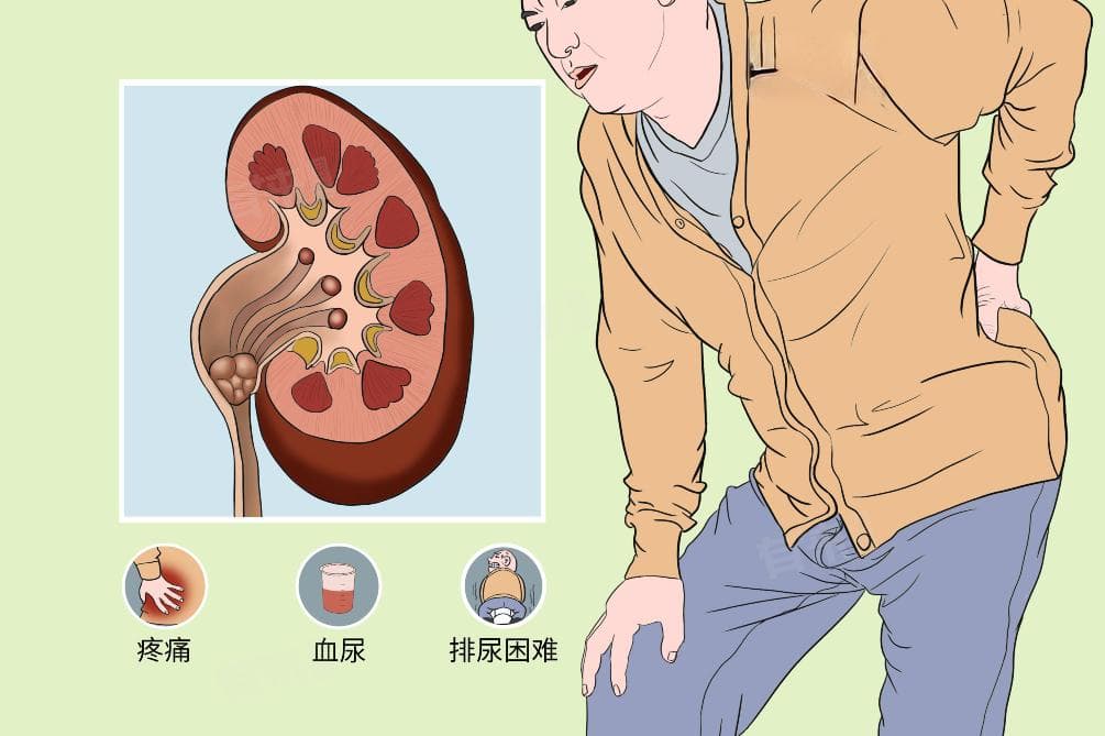 肾结石患者能否喝茶？一文详解饮茶注意事项