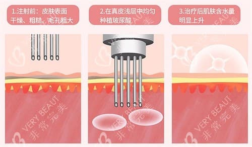 术唯可水光和嗨体水光哪个好？区别对比从成分、优缺点、价格、成效来分析~