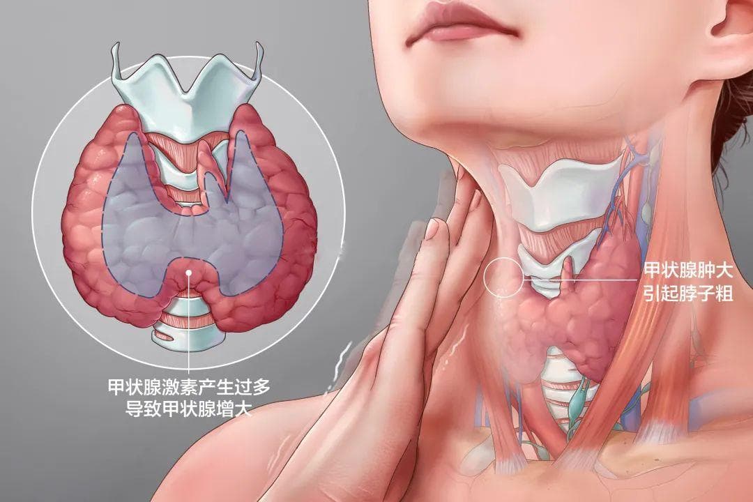 甲状腺功能亢进常见分型及表现