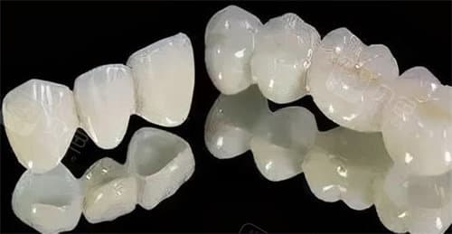 深度探讨！为了一颗牙搭桥值得吗？牙齿搭桥虽有其显著优势，但也存在一定的局限性！