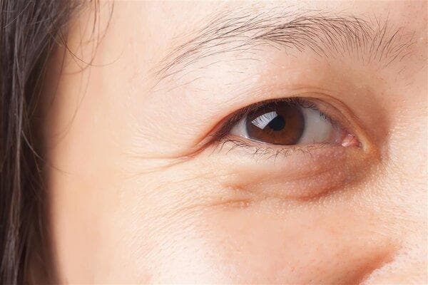 眼镜片发黄是什么原因