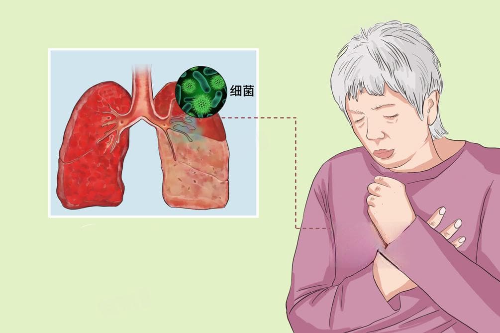 肺部感染会传染吗？不同类型肺部感染的传播途径和治疗方法