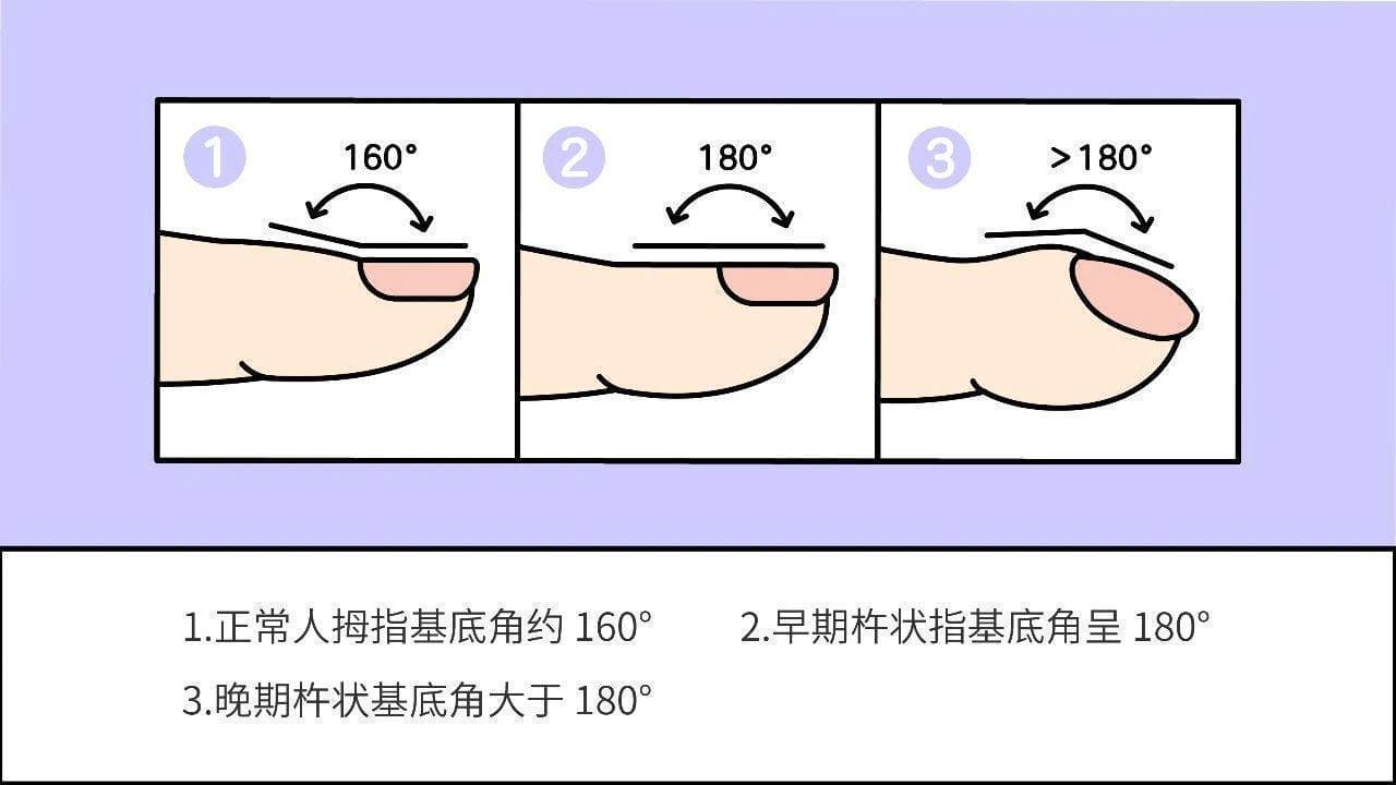 杵状指：症状、病因、诊断与治疗全解析