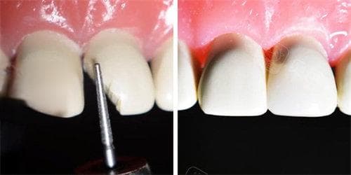 门牙断了一半怎么办？详解门牙断裂修复时间/补救办法