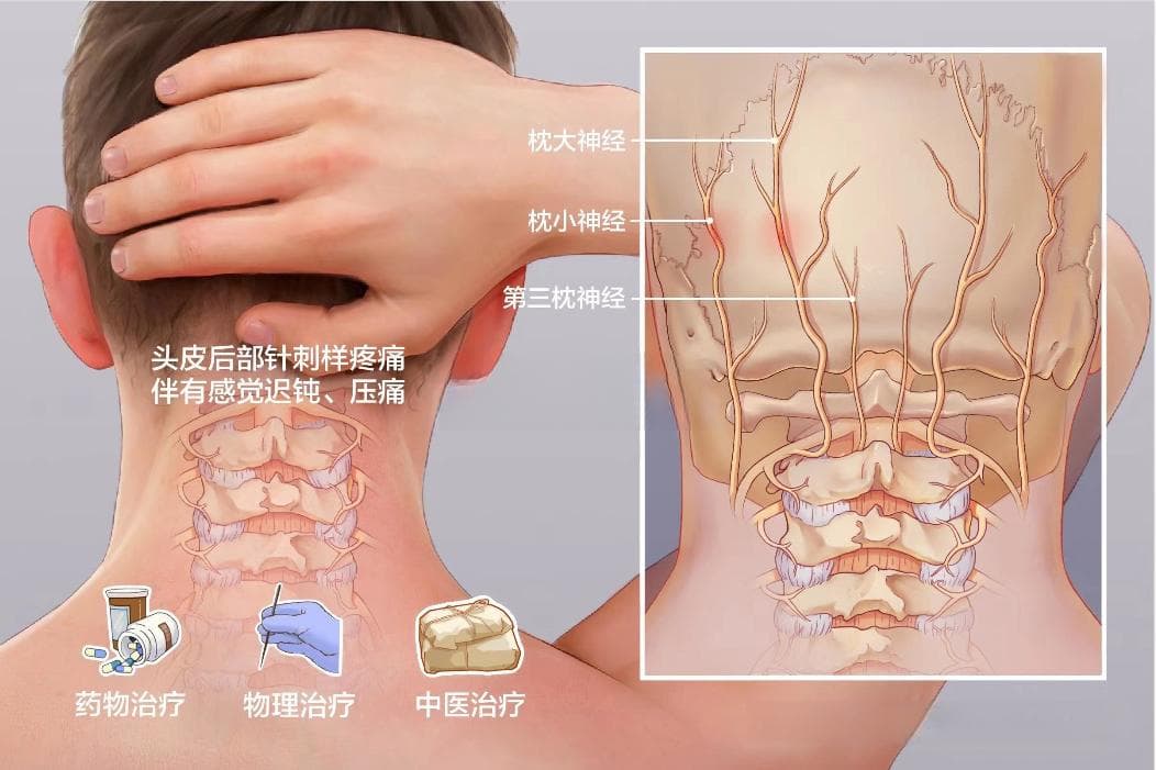 有一种头痛，叫枕神经痛！可以这样诊断和治疗