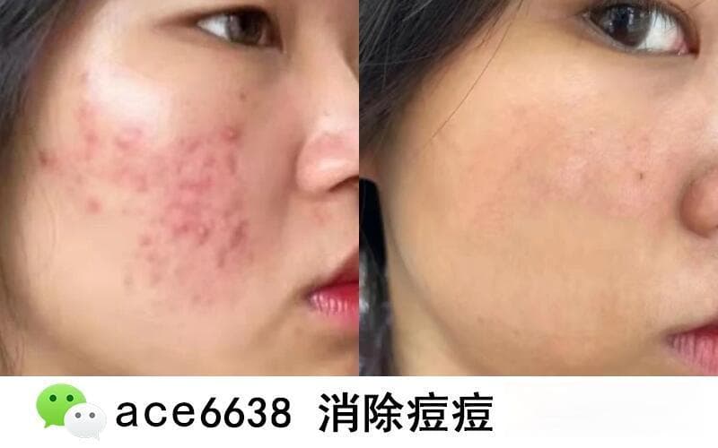 脸上长痘痘怎么内调 中医祛痘最有效的方法