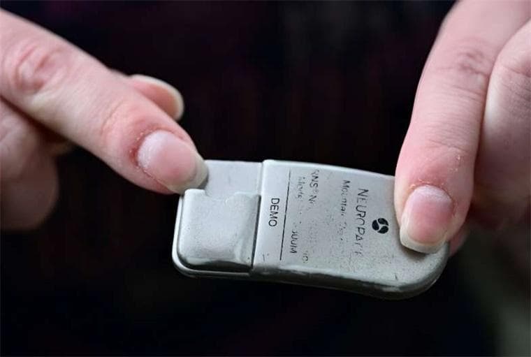 全球首例脑机接口治疗成功：女子癫痫强迫症双症齐消