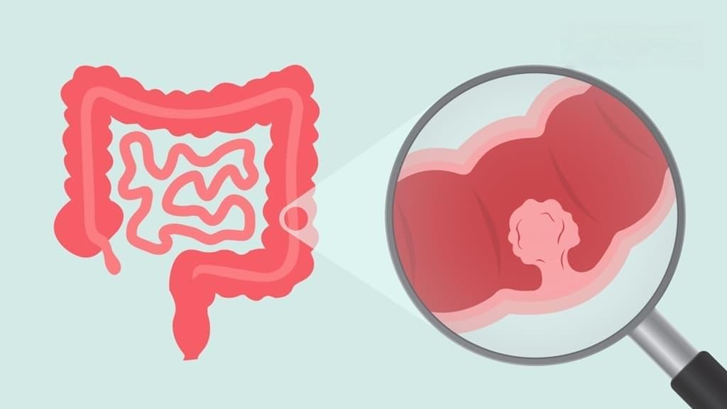 为什么容易长息肉？医生揭秘4种高风险人群，这样做可减少新息肉生成