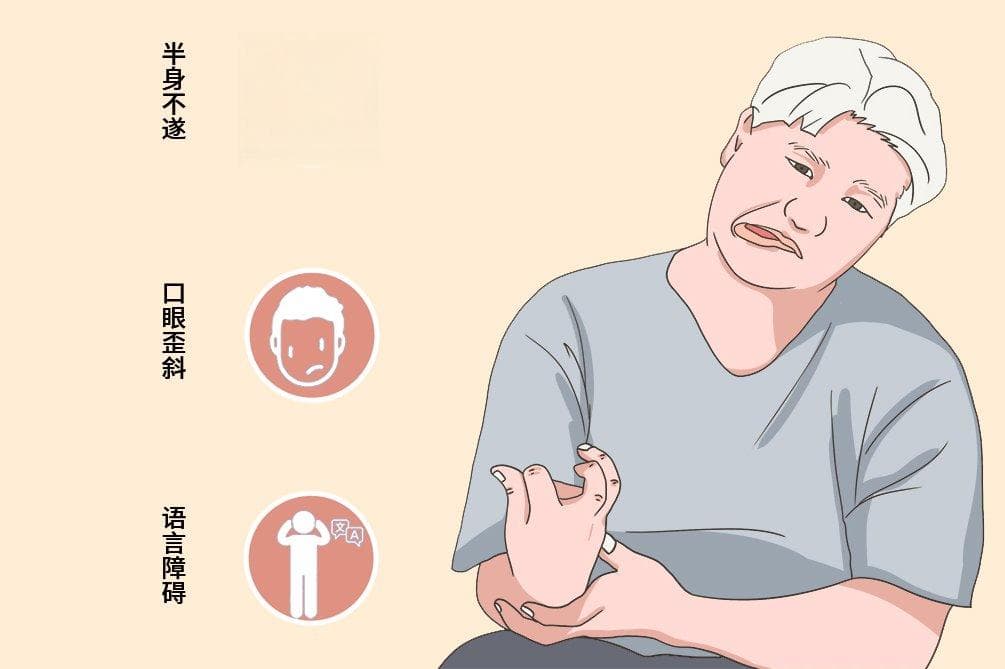 中风的前兆与急救：关键时刻的救命指南