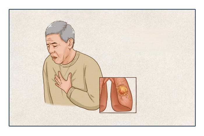 咳嗽久不愈、痰中带血丝？出现这些信号千万别硬扛！