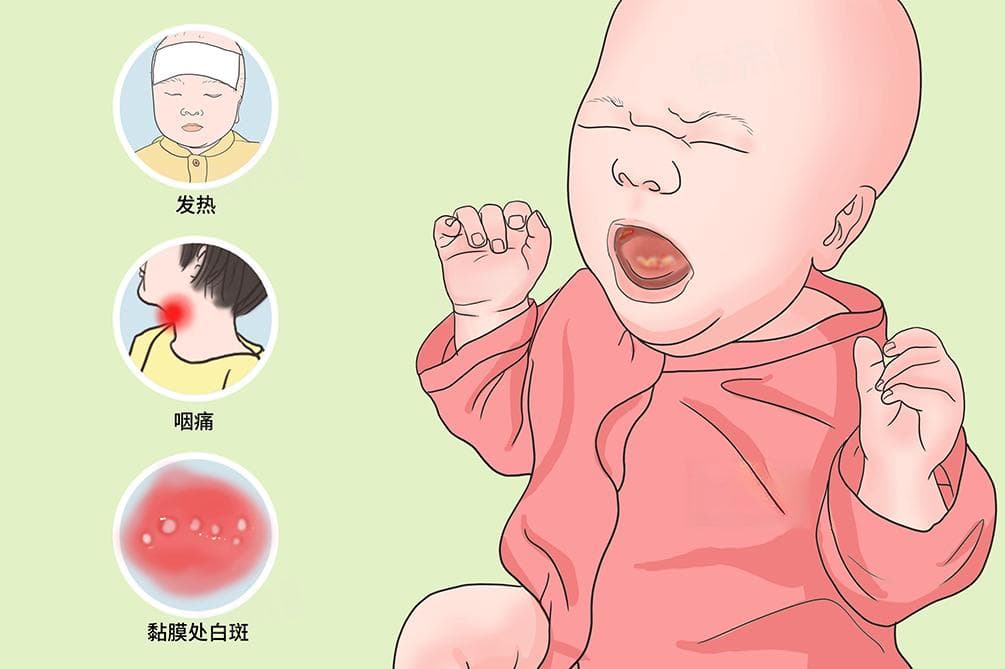 口腔炎的症状表现及预防措施