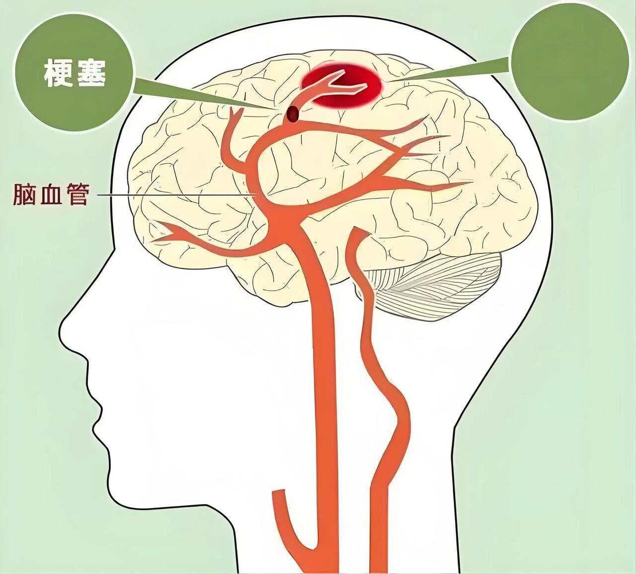 改善中老年脑供血不足，7个用药方案这样搭配