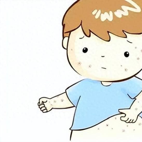 吡美莫司乳膏：不含激素，宝宝特应性皮炎首选