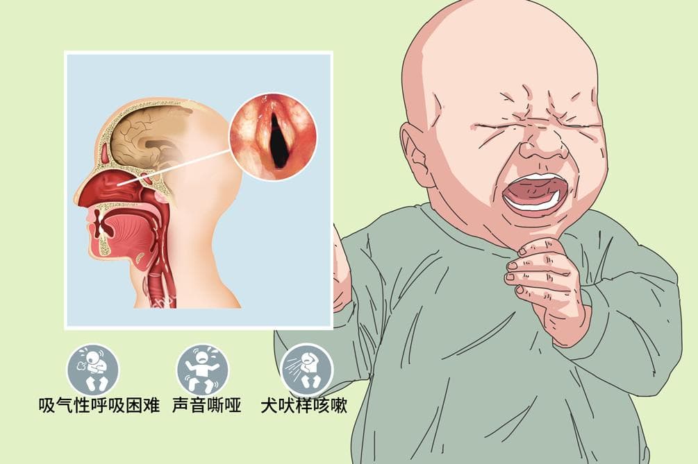 小儿夜间急性喉炎自救方法