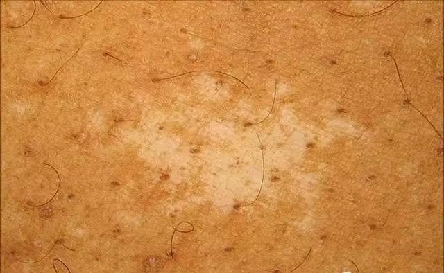 皮肤上的白斑都是白癜风吗？13种常见皮肤病全解析