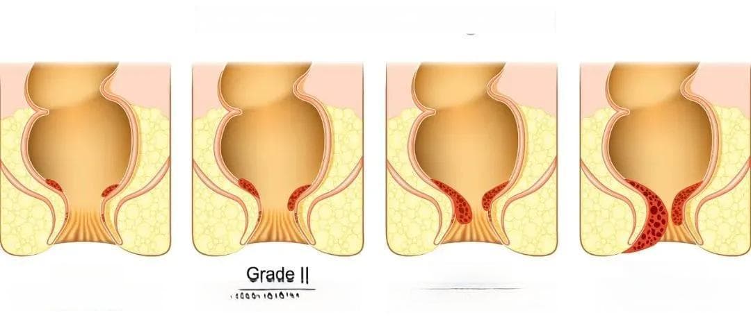 ASCRS最新指南：痔病诊疗有了新标准