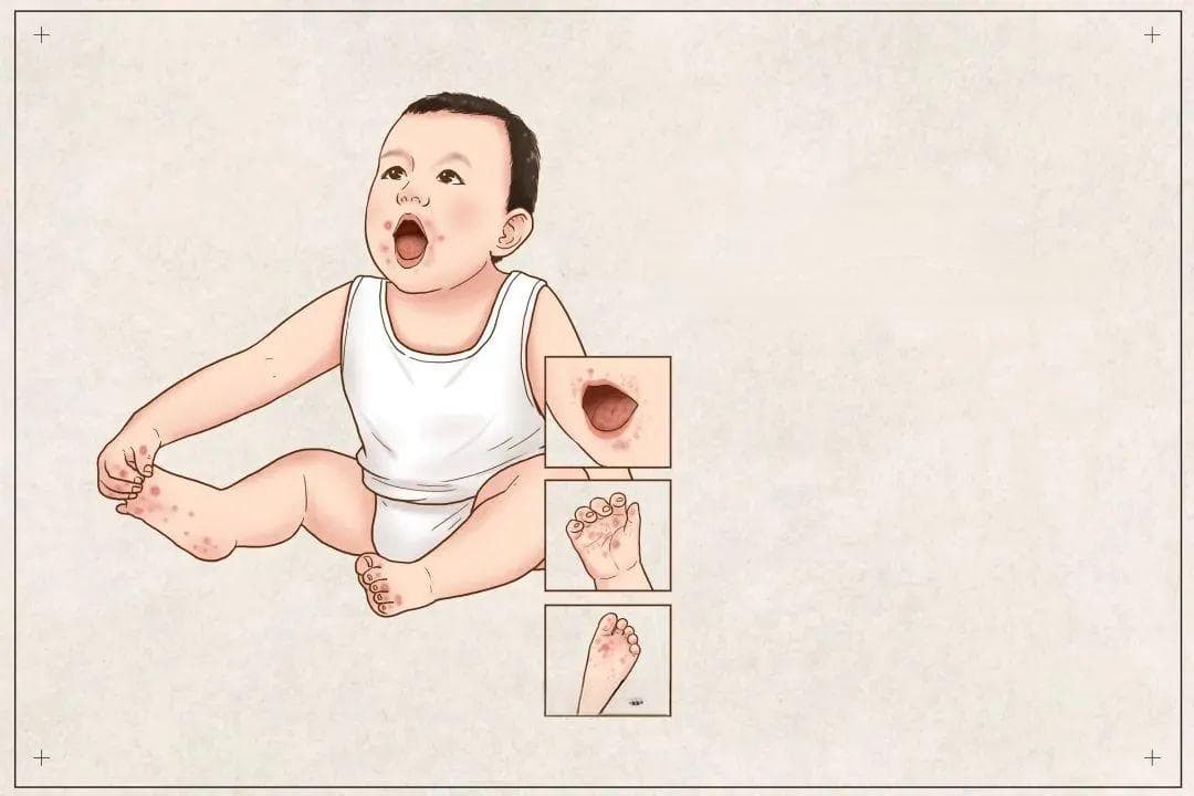 注意手足口病，守护小儿健康