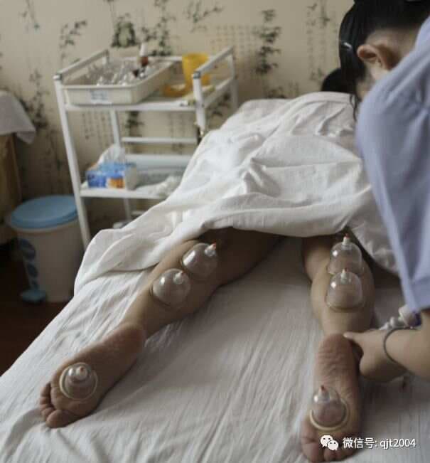探秘传统医学之瑰宝——拔罐治疗腿疼的取穴技巧