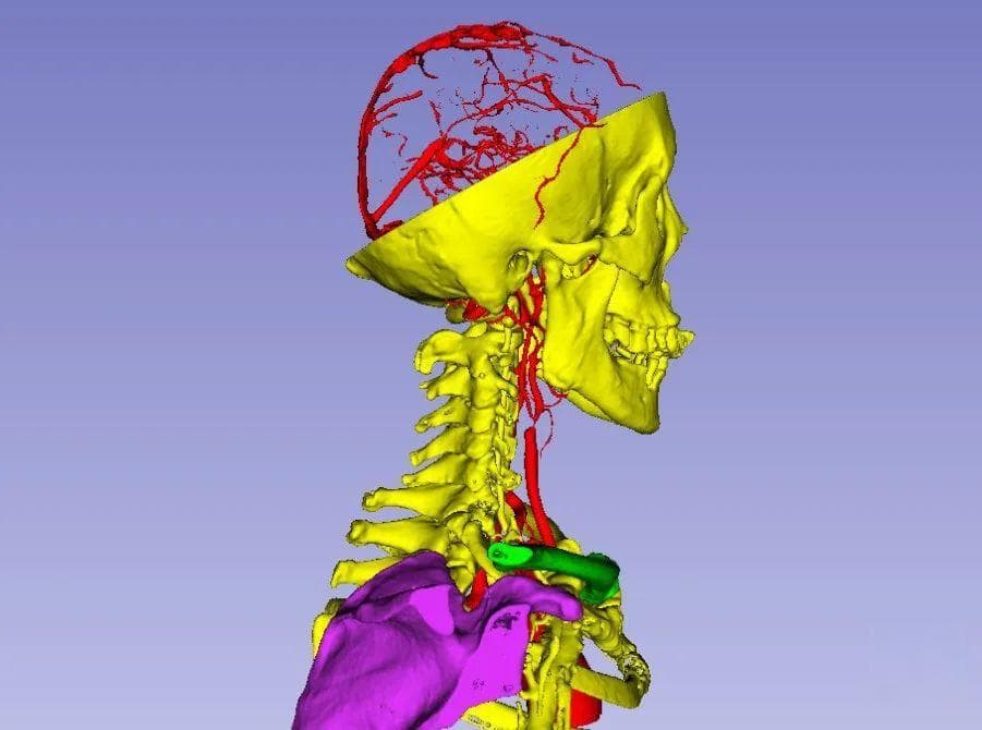 3D Slicer在颈动脉剥脱手术中的评估应用