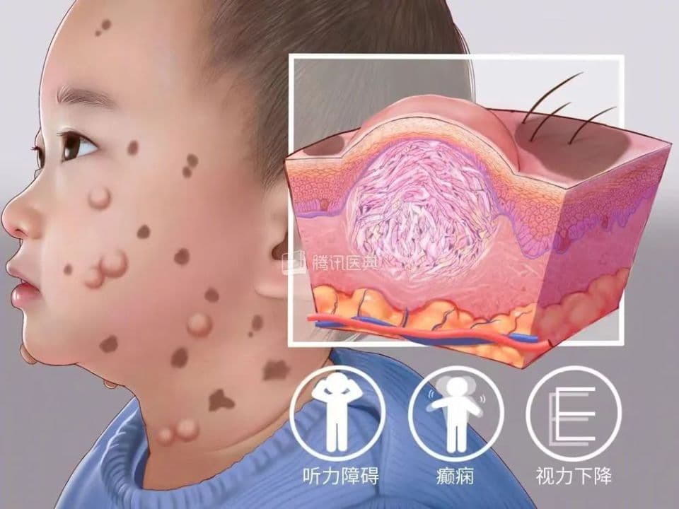 皮肤犹如“洒上牛奶咖啡”？警惕神经纤维瘤