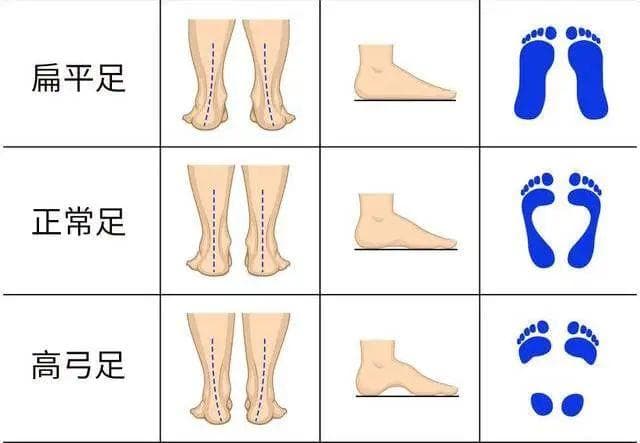 康复科普|扁平足的危害及治疗