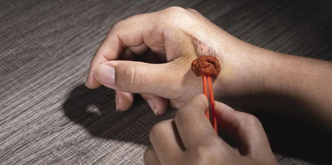 碘伏能美白还能祛痘？讲真，碘伏没有那么“万能”，生活中切勿滥用！