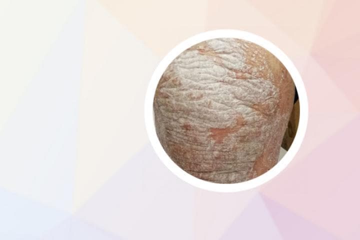 生物制剂治疗银屑病是什么 治疗银屑病生物制剂是什么