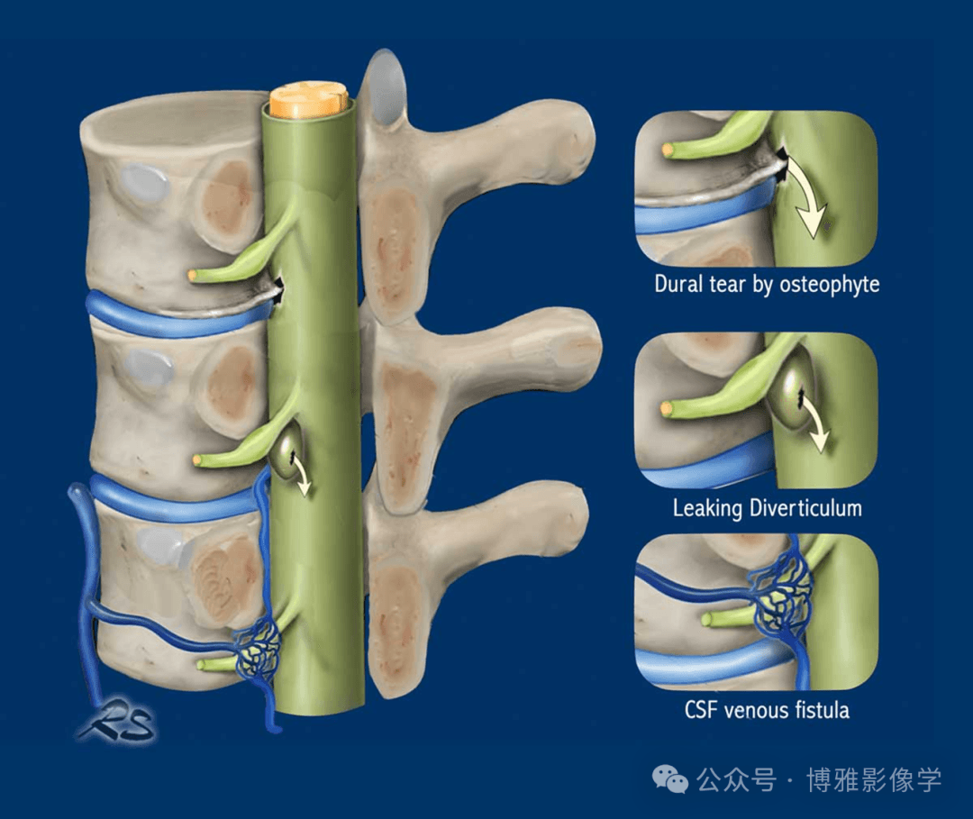 自发性低颅压综合征的影像学表现与诊断要点