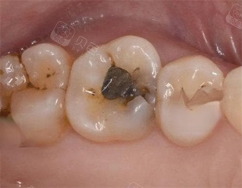 幼儿龋齿如何干预与治疗？尽早进行口腔涂氟、窝沟封闭等