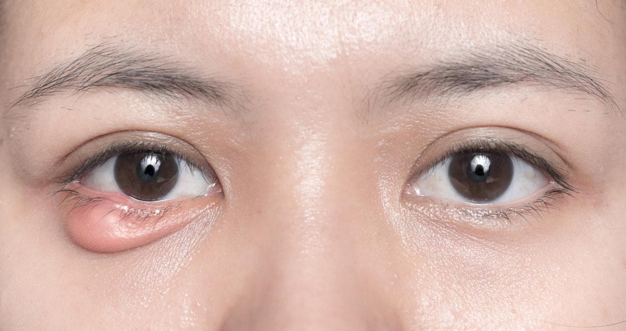 下眼睑肿了还疼？可能是这5种原因引起的