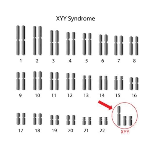 “XYY”不是天生坏种！基因遗传专家：不应恶魔化“超雄综合征”