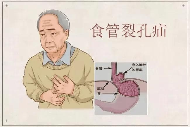 食管裂孔疝 vs 胃食管反流：症状区别与治疗指南