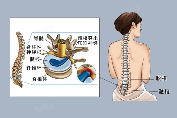 腰间盘突出怎么诊治