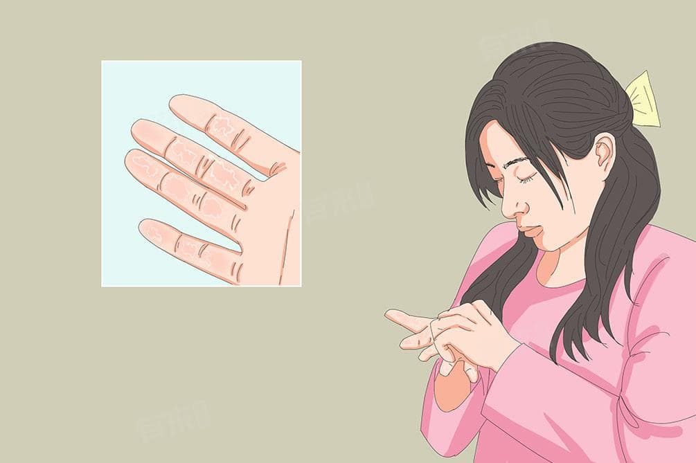 手指头掉皮怎么办？五种常见原因及处理方法