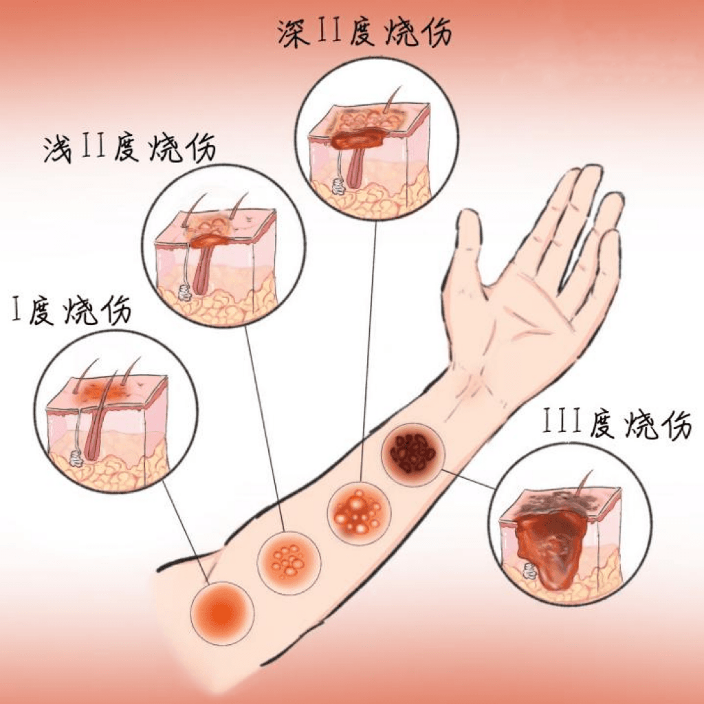 研究证实：重组贻贝粘蛋白水凝胶敷料显著改善浅II度烧伤创面修复效果