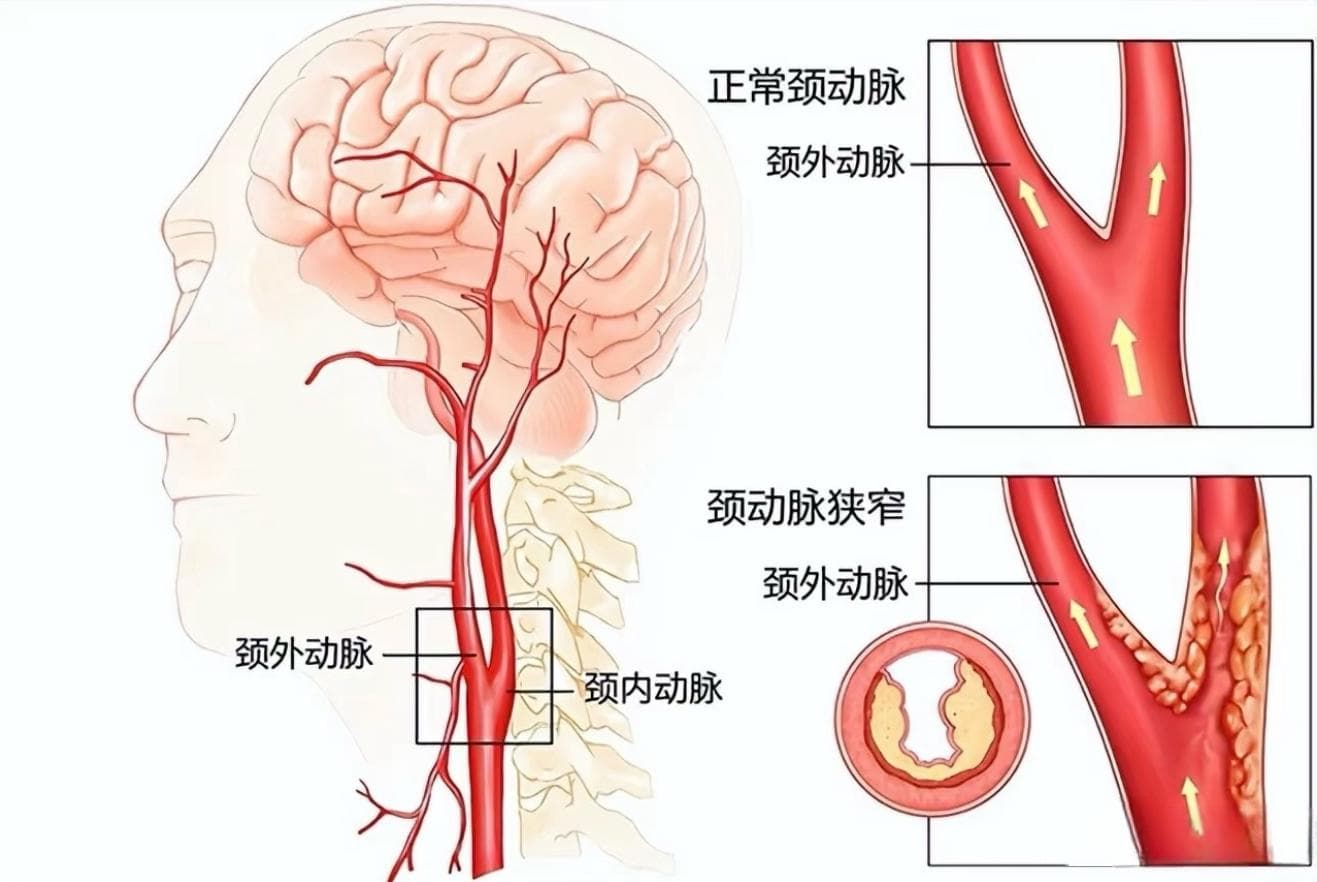 预防动脉硬化，从体检开始