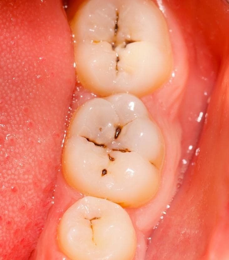 颧骨牙齿疼痛全攻略：病因、护理与治疗方案